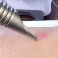 Behandlung mit Laser