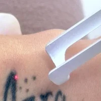Tattoo wird mit Laser entfernt